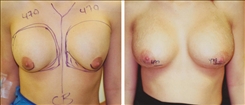 Breast Augmentation Patient Before & After Photo 1