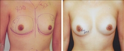 Breast Augmentation Patient Before & After Photo 1