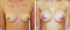 Breast Augmentation Patient Before & After Photo 1