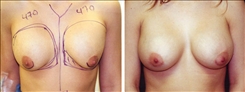 Breast Augmentation Patient Before & After Photo 1