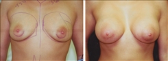 Breast Augmentation Patient Before & After Photo 1