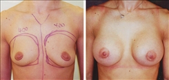 Breast Augmentation Patient Before & After Photo 1