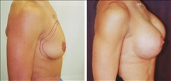 Breast Augmentation Patient Before & After Photo 1