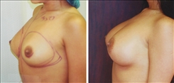 Breast Augmentation Patient Before & After Photo 1