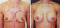 Breast Augmentation Patient Before & After Photo 1