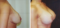 Breast Augmentation Patient Before & After Photo 1