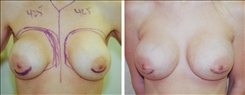 Breast Augmentation Patient Before & After Photo 1