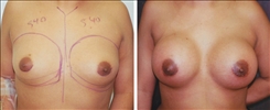 Breast Augmentation Patient Before & After Photo 1