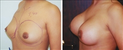 Breast Augmentation Patient Before & After Photo 1