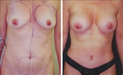 Breast Augmentation Patient Before & After Photo 1