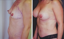 Breast Augmentation Patient Before & After Photo 1