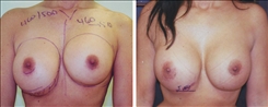 Breast Augmentation Patient Before & After Photo 1