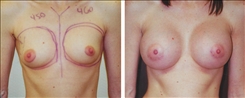 Breast Augmentation Patient Before & After Photo 1