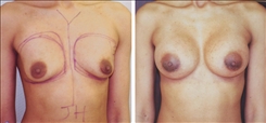 Breast Augmentation Patient Before & After Photo 1