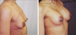 Breast Augmentation Patient Before & After Photo 1