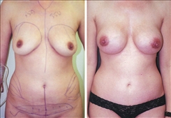 Breast Augmentation Patient Before & After Photo 1