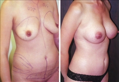 Breast Augmentation Patient Before & After Photo 1