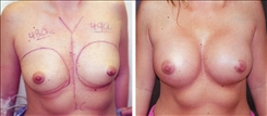 Breast Augmentation Patient Before & After Photo 1