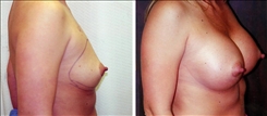 Breast Augmentation Patient Before & After Photo 1