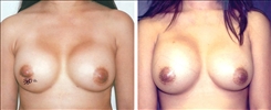 Breast Augmentation Patient Before & After Photo 1