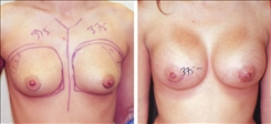 Breast Augmentation Patient Before & After Photo 1