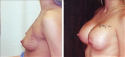 Breast Augmentation Patient Before & After Photo 1