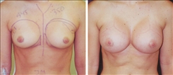 Breast Augmentation Patient Before & After Photo 1