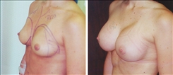 Breast Augmentation Patient Before & After Photo 1