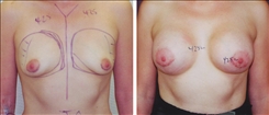 Breast Augmentation Patient Before & After Photo 1