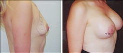 Breast Augmentation Patient Before & After Photo 1