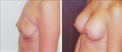 Breast Augmentation Patient Before & After Photo 1