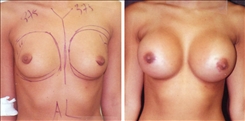 Breast Augmentation Patient Before & After Photo 1