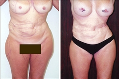 Breast Augmentation Patient Before & After Photo 1