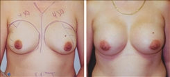 Breast Augmentation Patient Before & After Photo 1