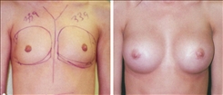 Breast Augmentation Patient Before & After Photo 1