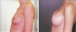 Breast Augmentation Patient Before & After Photo 1