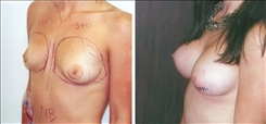 Breast Augmentation Patient Before & After Photo 1