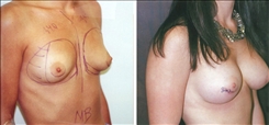 Breast Augmentation Patient Before & After Photo 1