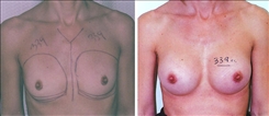 Breast Augmentation Patient Before & After Photo 1