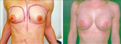 Breast Augmentation Patient Before & After Photo 1