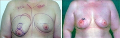 Breast Augmentation Patient Before & After Photo 1