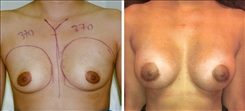 Breast Augmentation Patient Before & After Photo 1