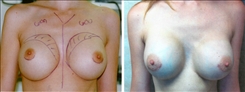 Breast Augmentation Patient Before & After Photo 1