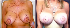 Breast Augmentation Patient Before & After Photo 1