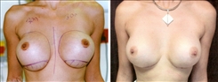 Breast Augmentation Patient Before & After Photo 1