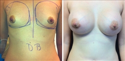 Breast Augmentation Patient Before & After Photo 1