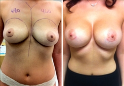 Breast Augmentation Patient Before & After Photo 1