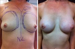 Breast Augmentation Patient Before & After Photo 1