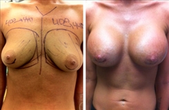 Breast Augmentation Patient Before & After Photo 1