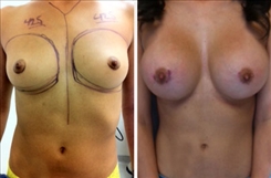 Breast Augmentation Patient Before & After Photo 1